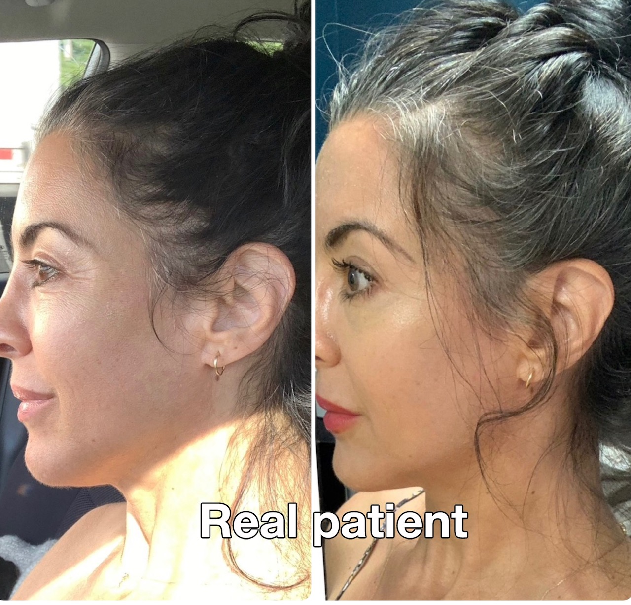Real patient additional hair restoration result