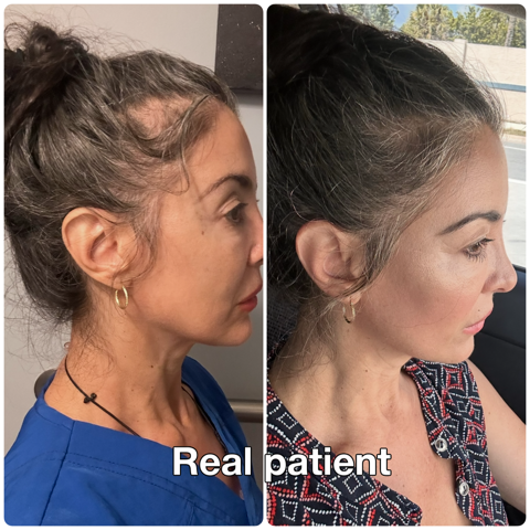 Real patient before and after hair restoration treatment